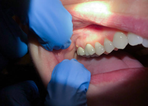 Best Dental Abscess Treatment in San Diego, TX