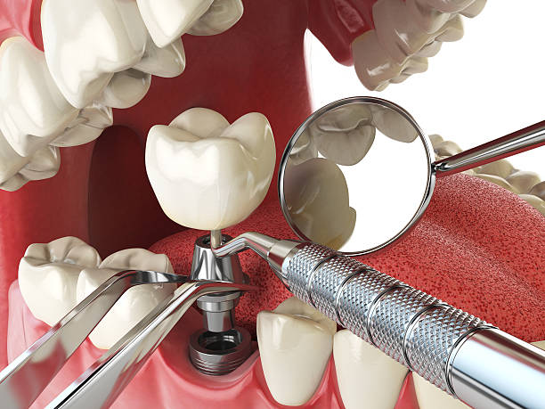 Best Broken or Chipped Tooth Repair in San Diego, TX